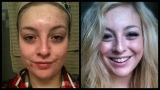 End of Accutane Before and After [upl. by Ojoj]