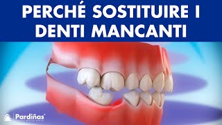 Implantologia  Conseguenze di non sostituire il denti mancanti © [upl. by Uaeb92]