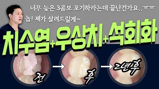 실패한 신경치료 🥶결국 대학병원 의뢰서를 받았지만 🙏여기서도 될까요❓석회화된 신경치료우상치치료미세현미경치과 [upl. by Lamrouex]