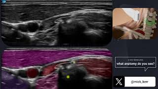 The brachial plexus anatomy sonoanatomy  above the clavicle [upl. by Shirlene]