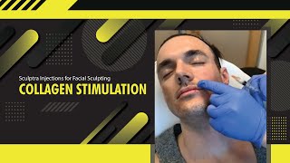 Sculptra Injections for Facial Sculpting  Collagen Stimulation  Dr Jason Emer  LIVE [upl. by Ajup]