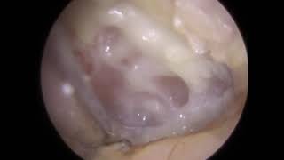 Infected Debris and Thick Discharge Microsuction from Ear Canal and off Eardrum  348 [upl. by Alurta585]