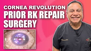 Corneal RK Radial Keratotomy Repair with Topographic Guided Ablation [upl. by Rheims]