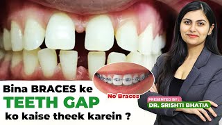 BINA BRACES ke TEETH GAP jaldi kaise theek kren Dr Srishti Bhatia teeth smile teethgapmakeover [upl. by Pincince505]