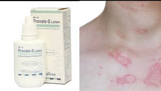 Allergy Eczematreatment in urduProvate S lotion Uses benefits and disadvanteges in urdu [upl. by Antoni]