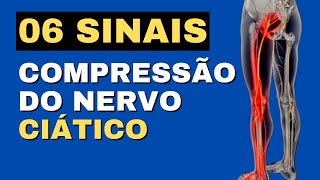 06 Sintomas de Compressão do Nervo Ciático [upl. by Boehike952]