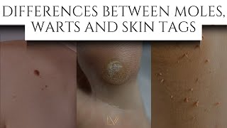 Differences Between Moles Warts and Skin tags skincare [upl. by Witte]