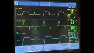 Ventilator Graphic with Air Leak secondary to Bronchopleural Fistula [upl. by Beesley931]