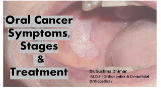 Oral cancer Non healing ulcersoraldisease  Comprehensive Guide to Oral Squamous Cell Carcinoma [upl. by Darton853]