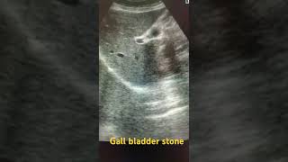 Gallbladder stone ultrasound medical gallstone shortfeed abdomen study ytviral shortsviral [upl. by Itak]