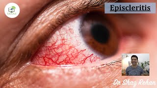 Episcleritis What is it How is it Diagnosed How is it Treated I Dr Shaz Rehan 2021 [upl. by Nahn]