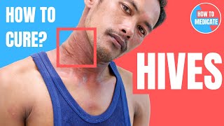 How to treat Hives Urticaria  Doctor Explains [upl. by Trella242]