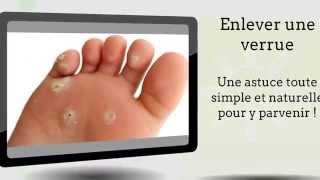 Enlever une verrue  Mon astuce simple et efficace pour y arriver [upl. by Gilberto]