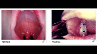 Koplik spots measles rubeola virus [upl. by Etyak]