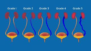 What is Vesicoureteral Reflux VUR  Animated Video [upl. by Maren]