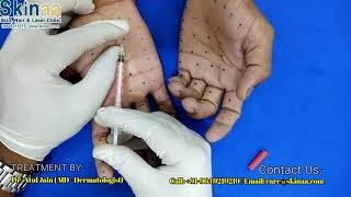 Botox Therapy for Palmer Hyperhidrosis Sweaty Hands  Skinaa Clinic Jaipur [upl. by Ahsait]