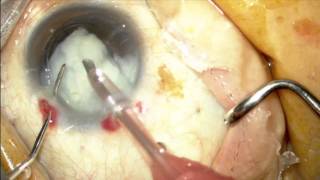 HD Intumescent cataract surgery [upl. by Edaw542]