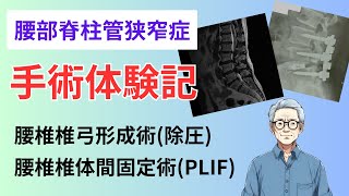 腰部脊柱管狭窄症 手術体験記 [upl. by Kraft]