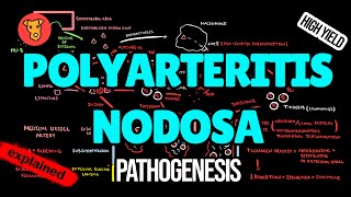 POLYARTERITIS NODOSA Pathogenesis Mechanism of Clinical symptoms Treatment [upl. by Conte]