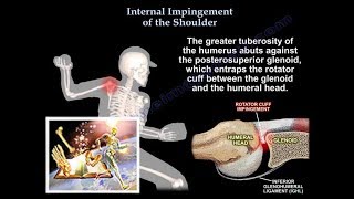 Internal Impingement of the shoulder Everything You Need To Know  Dr Nabil Ebraheim [upl. by Acimat]