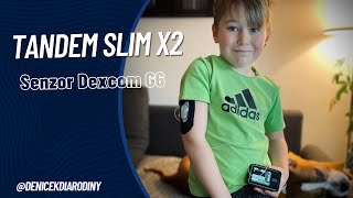 Nasazení inzulínové pumpy Tandem  senzor Dexcom G6 [upl. by Yremogtnom]