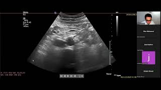 Acute versus Chronic Ischemia Arterial Doppler Ultrasound [upl. by Jaala]