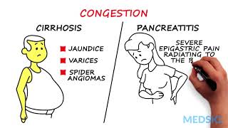 Splenomegaly Remember the 3 primary causes with CIP [upl. by Elburt]