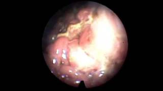 TransNasal Esophagoscopy TNE Esophageal Candidiasis [upl. by Deanna996]