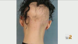 Eczema Treatment Helping Some Alopecia Sufferers Regrpw Hair [upl. by Derfla]