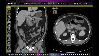 Dolor abdominal crónico es colitis [upl. by Liebermann102]