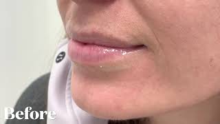 Watch This Lip Filler Transformation With Just One Syringe Of Juvéderm Volbella [upl. by Atiniv]