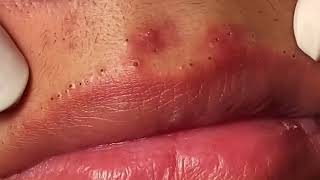 Most Painful Blackhead Removal on Lips [upl. by Annod]