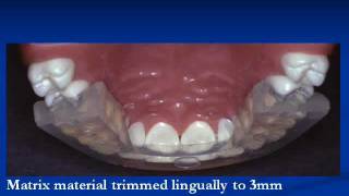 Rapid Simplified Veneer Provisionals RSVP  Cosmedent [upl. by Nerine374]