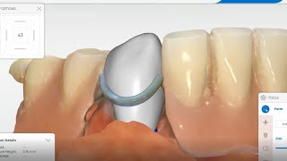 Cerec Primescan  Crown under partial denture [upl. by Arahsit33]