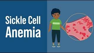 Sickle Cell Anemia [upl. by Eon]