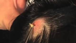 The Botfly in the Head [upl. by Ressler]