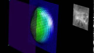 Custom Wavefront Guided Lasik Procedure [upl. by Ardekan]