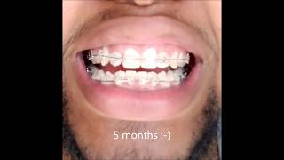 Braces 6 Month Timelapse [upl. by Stamata]