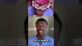 Hyperdontia is a condition where a person has extra teeth known as supernumerary teeth hyperdontia [upl. by Enelkcaj]