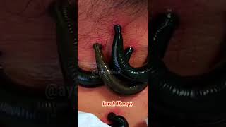 leeches cure  leeches therapy Ayurveda  panchkarma  shorts [upl. by Nart]