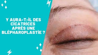 Y auratil des cicatrices après une blépharoplastie [upl. by Paula144]