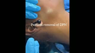 Painless removal of DPN by cautery —Dr Aiswarya S R [upl. by Dohsar]