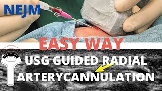 USG Guided Radial Artery Cannulation  A different approach  NEJM Tutorial [upl. by Llehsram]