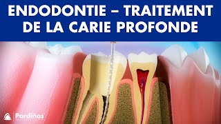 Endodontie  Traitement de la carie profonde © [upl. by Wolfgang]