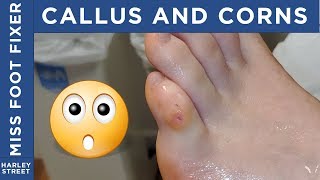 Corn and Callus non invasive removal By Miss Foot Fixer Marion Yau [upl. by Nedda]