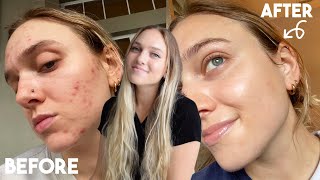 How I Healed My Adult Cystic Hormonal Acne Naturally  My Skincare Journey [upl. by Virgilia]