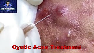 Cystic Acne Treatment  Cyst and Blackhead extraction  Pimple Popping  Clogged Pores [upl. by Hibbs]