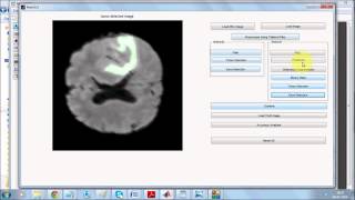 Analysis of Brain Tumor Detection Techniques through Filtering and Segmentation in Matlab [upl. by Ulla]