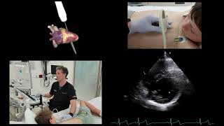 How to perform a paeds POCUS echo and lung study Live case [upl. by Velleman]