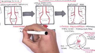 Abdominal Aortic Aneurysm  Summary [upl. by Ellekcim]